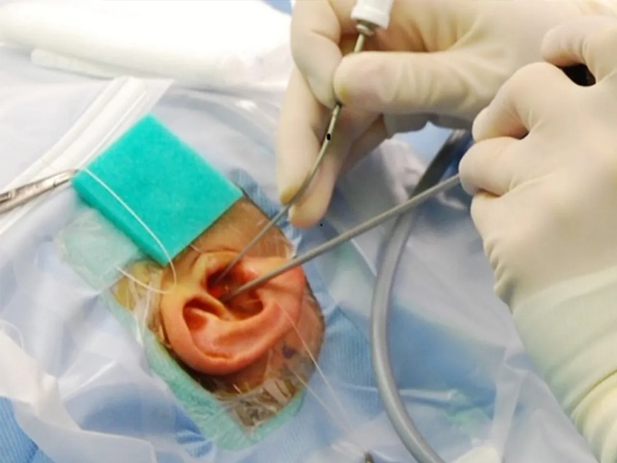 The process and methods of ear surgery