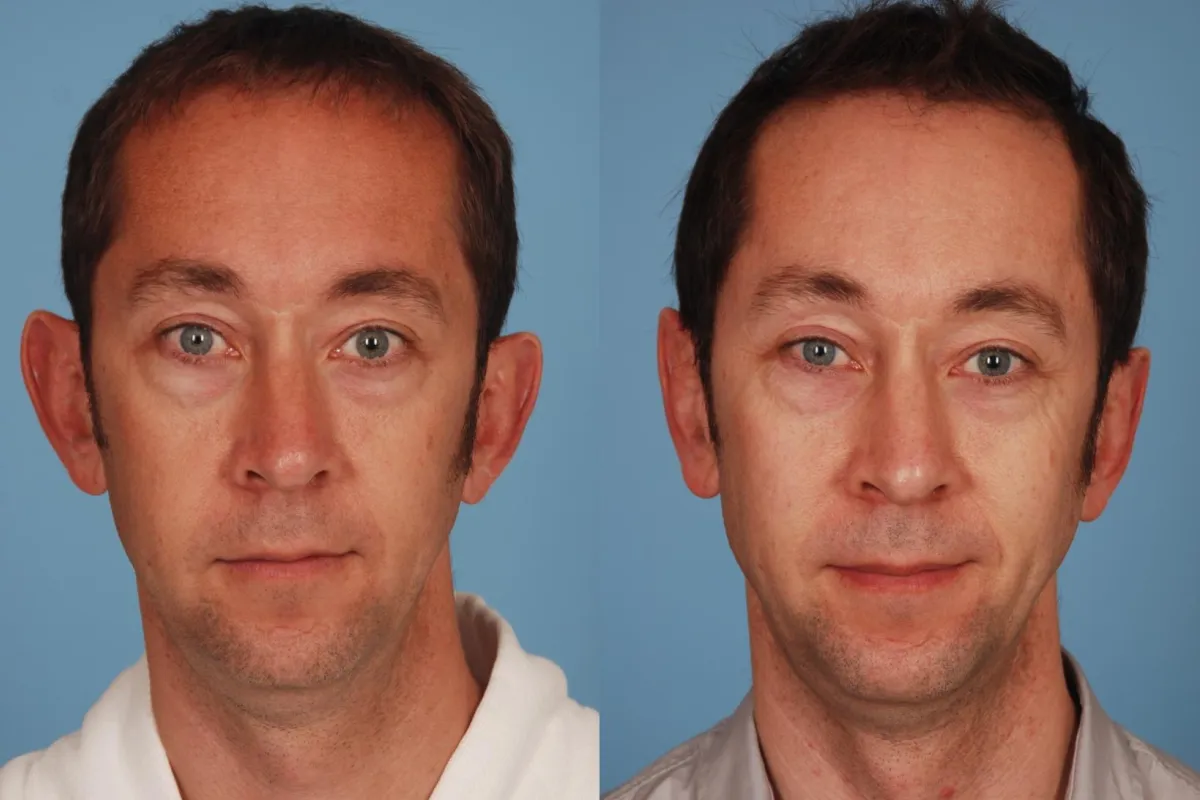 Benefits and results of ear surgery