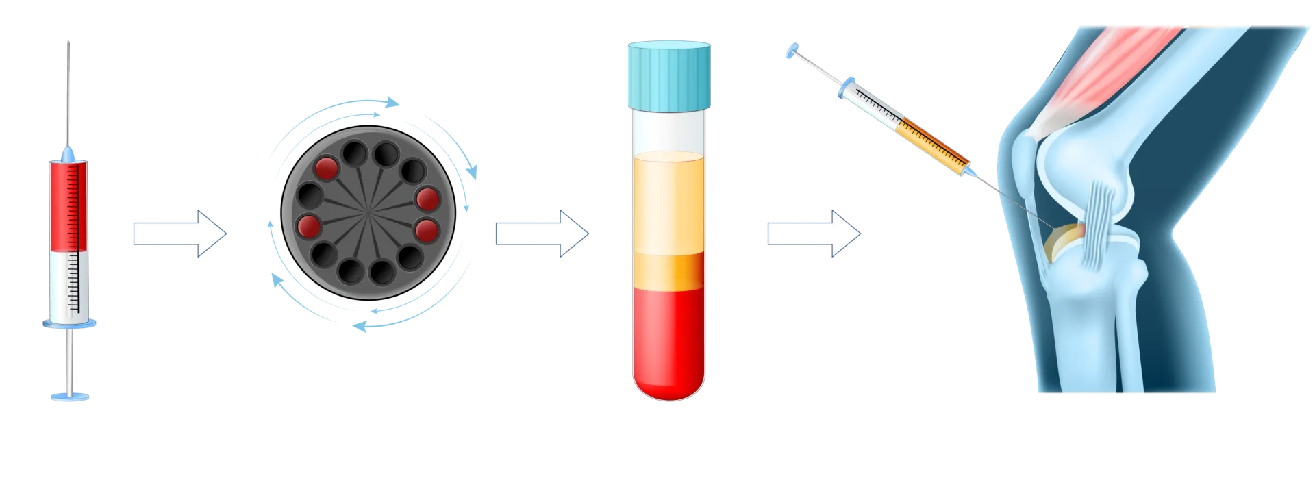 خطوات إجراء علاج PRP