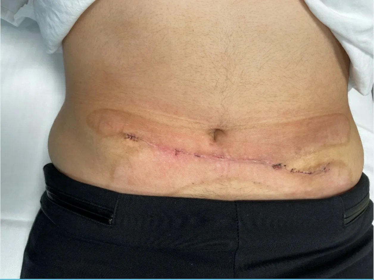 腹部和侧腰手术可能并发症及预防方法