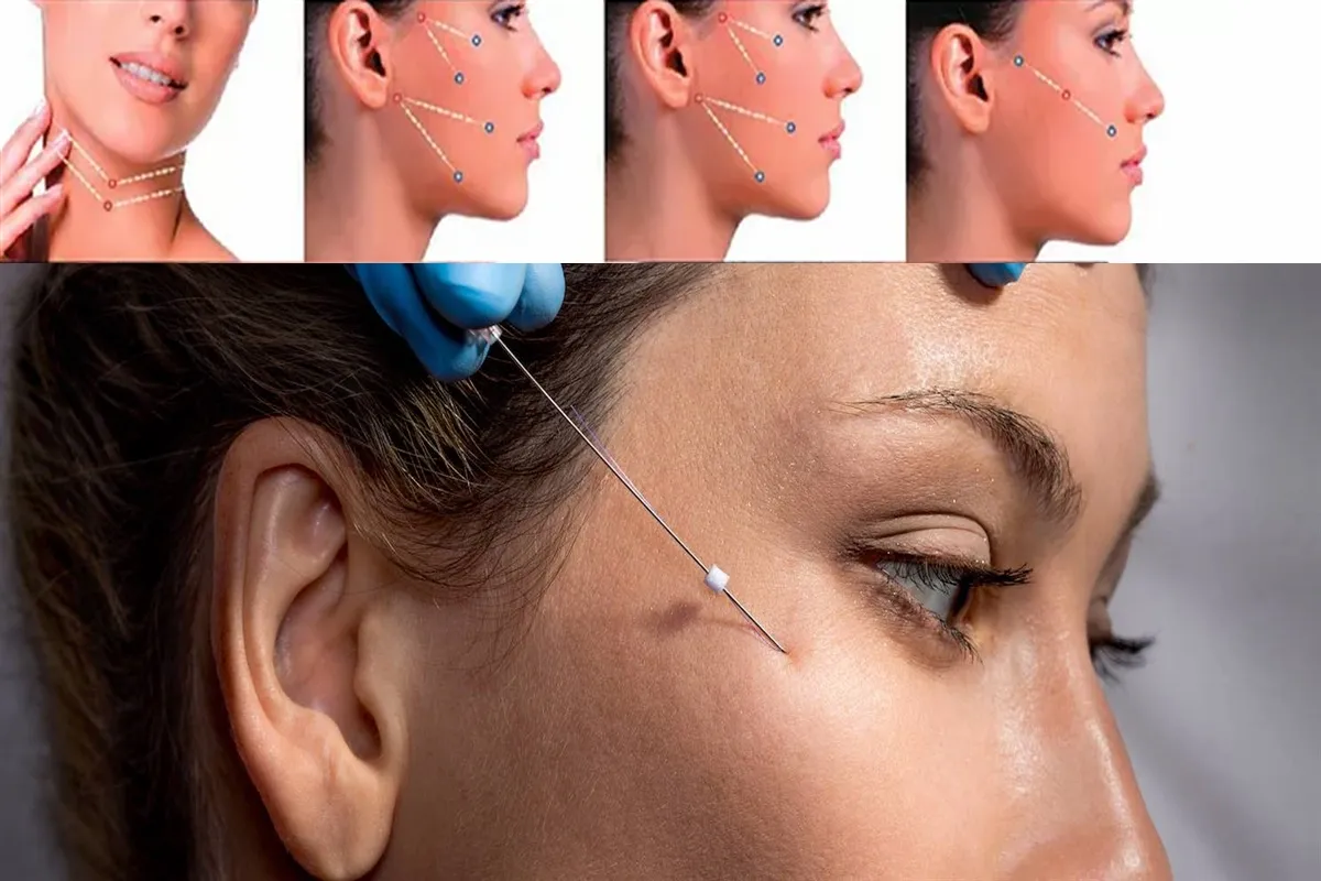 Thread Lift: Introduction, Aftercare, and the Best Clinics Worldwide