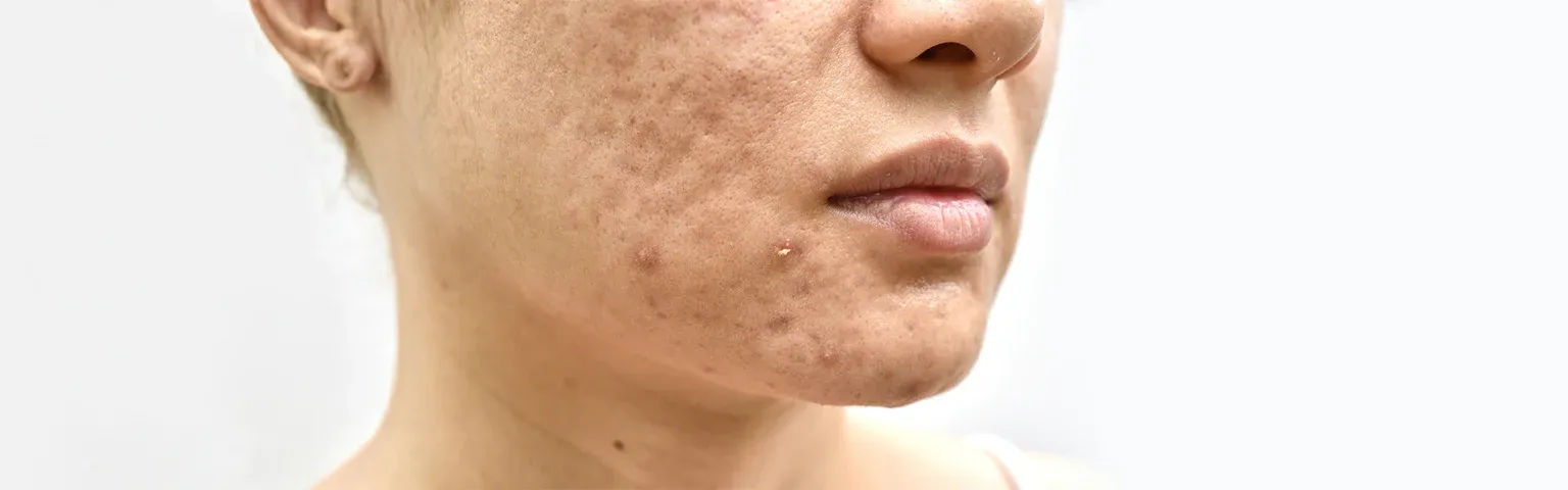 Lazer veya Mikroiğne ile Akne İzi ve Skar Tedavisi | Bilimsel ve Doğru Karşılaştırma