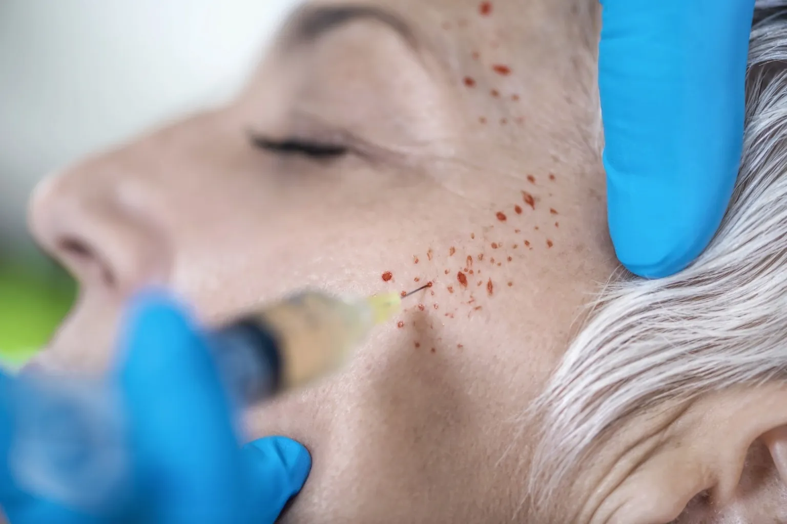 التطبيقات الجمالية لعلاج PRP