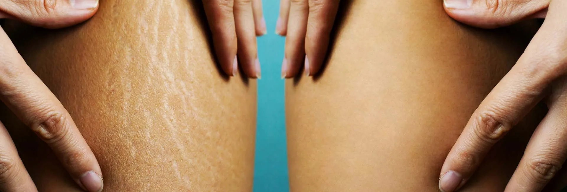Stretch Mark Treatment